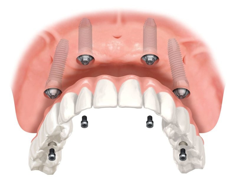 What is All-on-Four Dental Implants
