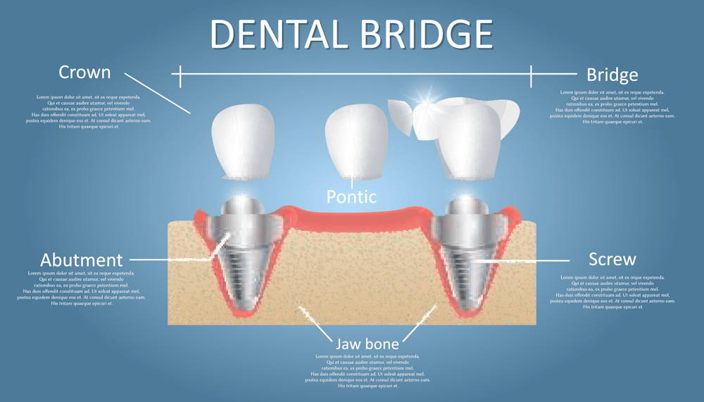 Dental Bridges
