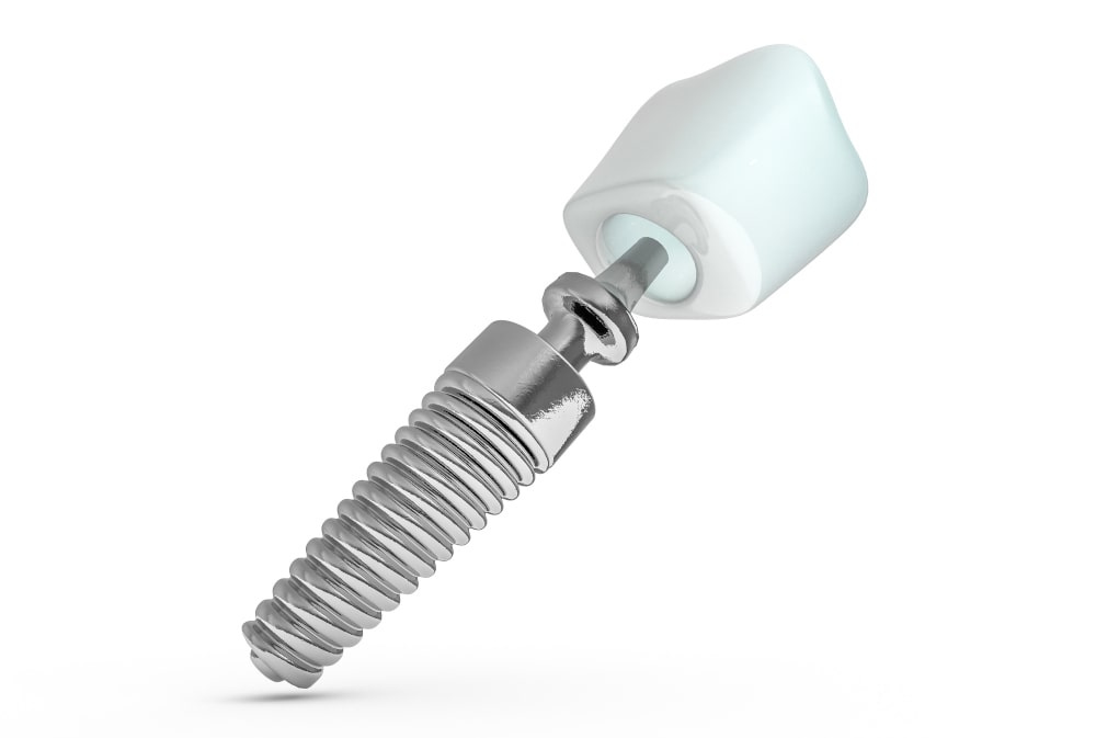 Why is Zirconia Considered a Metal-Free Implant Option?