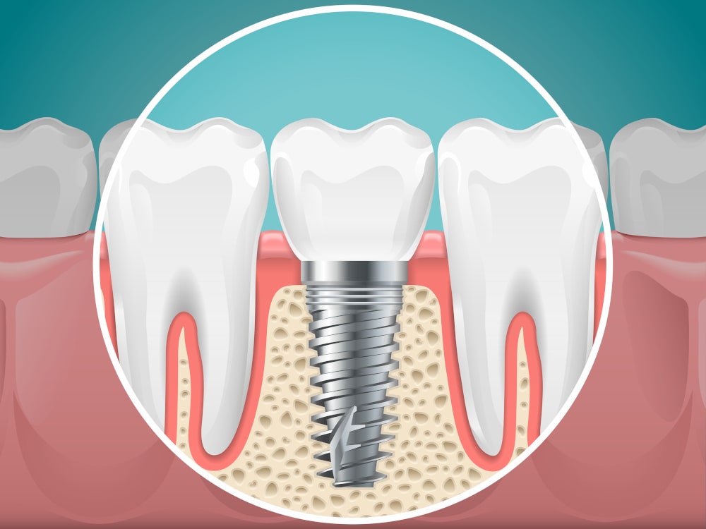 Types of Dental Implant Materials