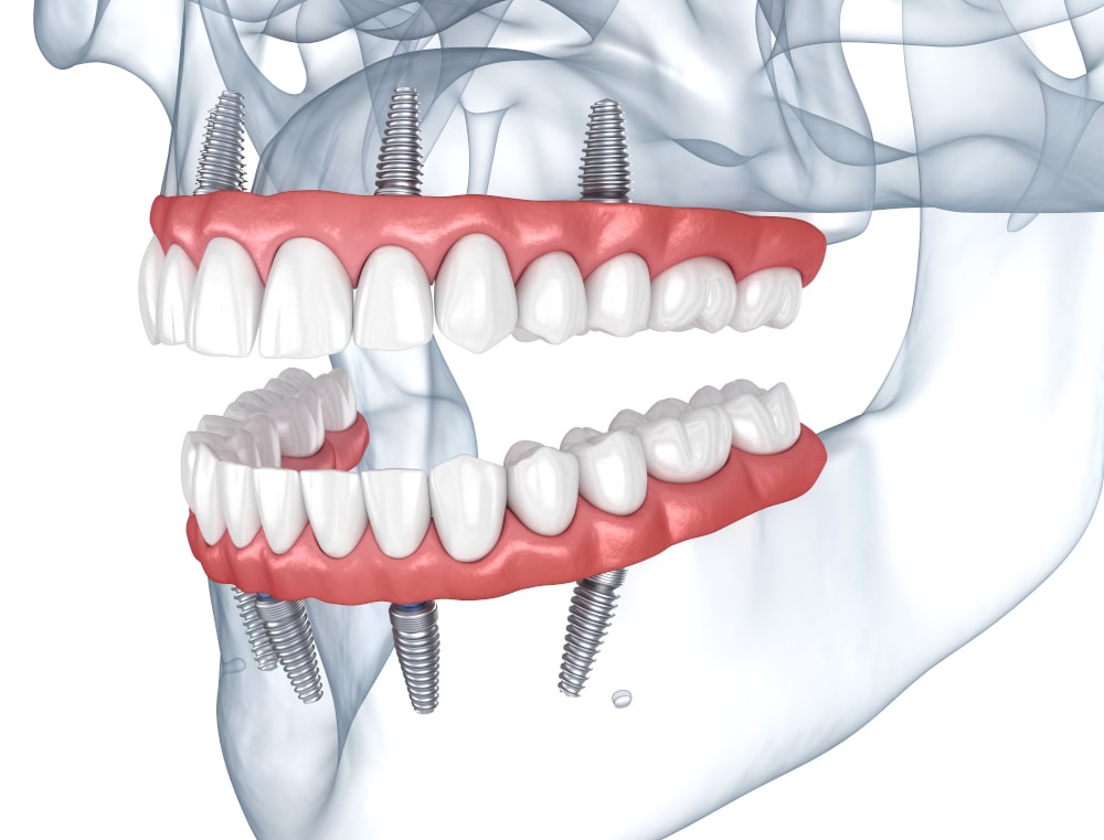 Patient All-on-4 dental implants cleaning