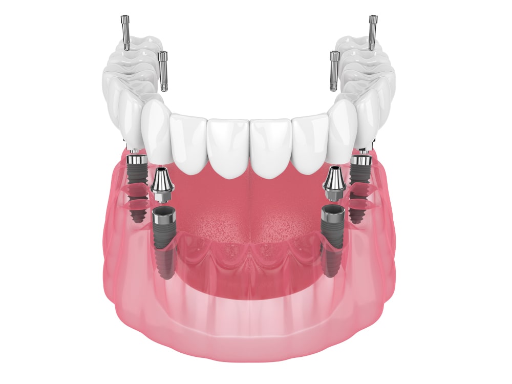 Titanium implant posts and prosthetic bridge in All-on-4 system