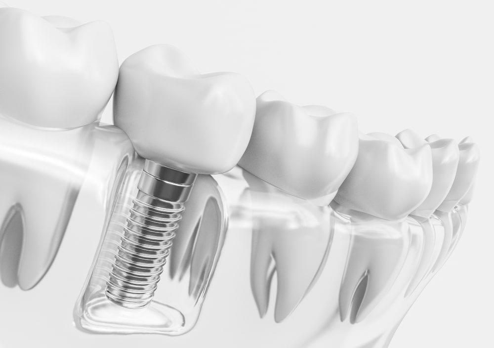 Healing stages after tooth extraction with blood clot and tissue regeneration