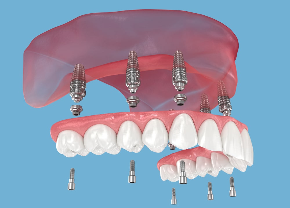 3D view of a full-arch prosthesis supported by six dental implants