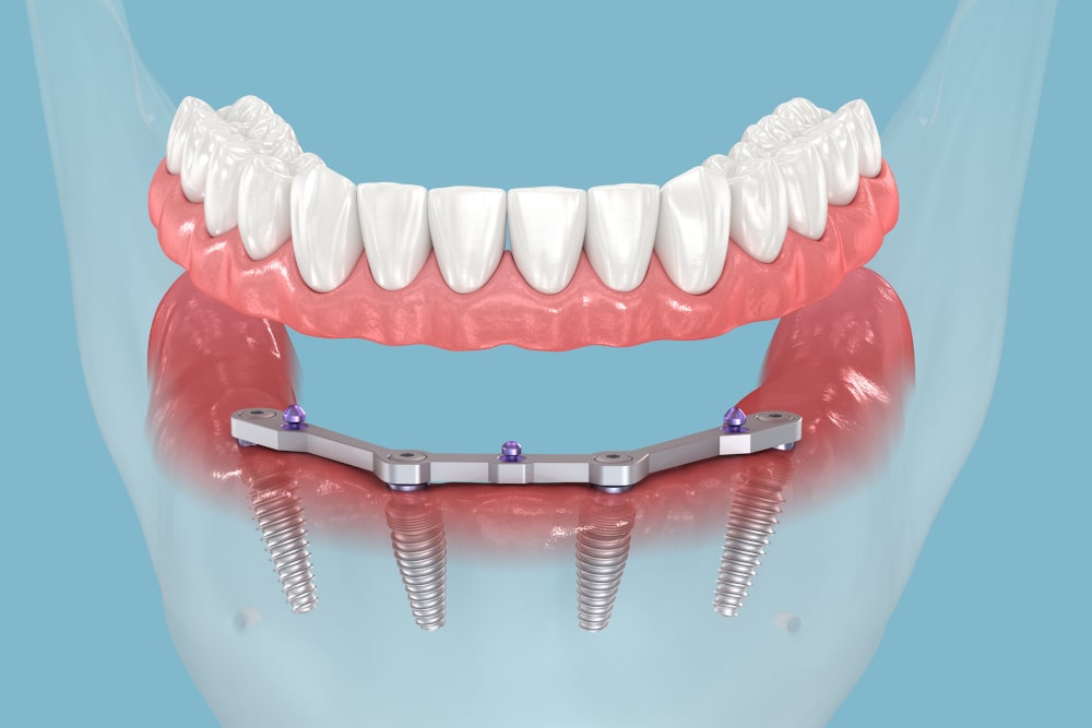 Close-up of All-on-4 dental prosthesis showing implant-supported structure