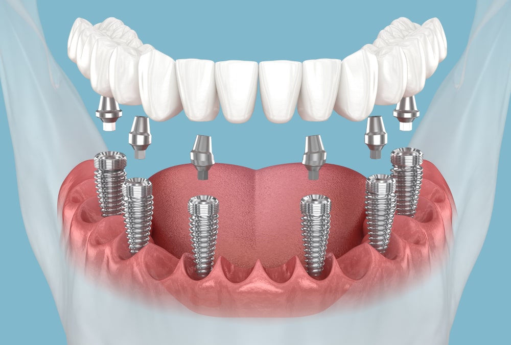 Mandibular Prosthesis Using All-on-6 Implant System