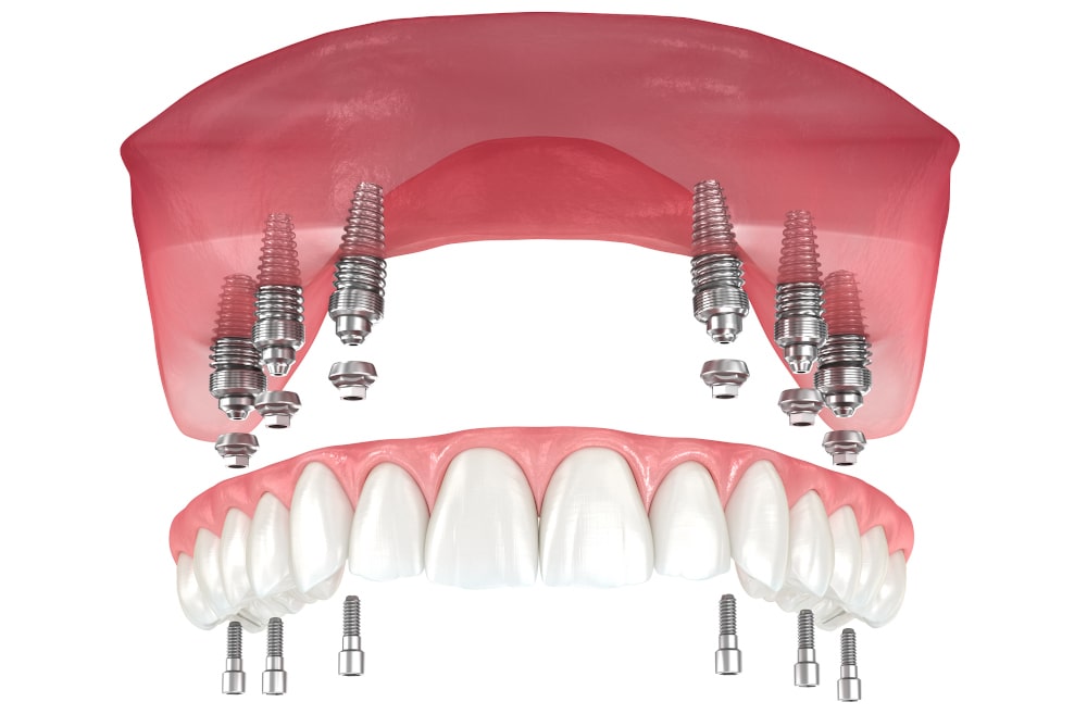Upper jaw (maxilla) prosthesis showing gum structure with six implants (All-on-6 system)