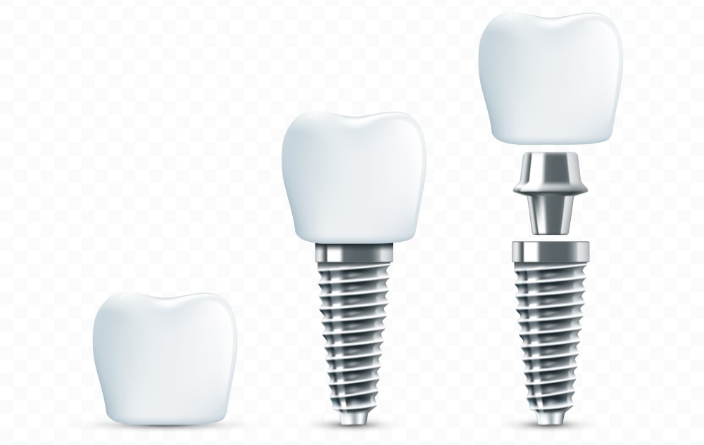 Detailed vector mockup of dental implant anatomy for educational and insurance purposes