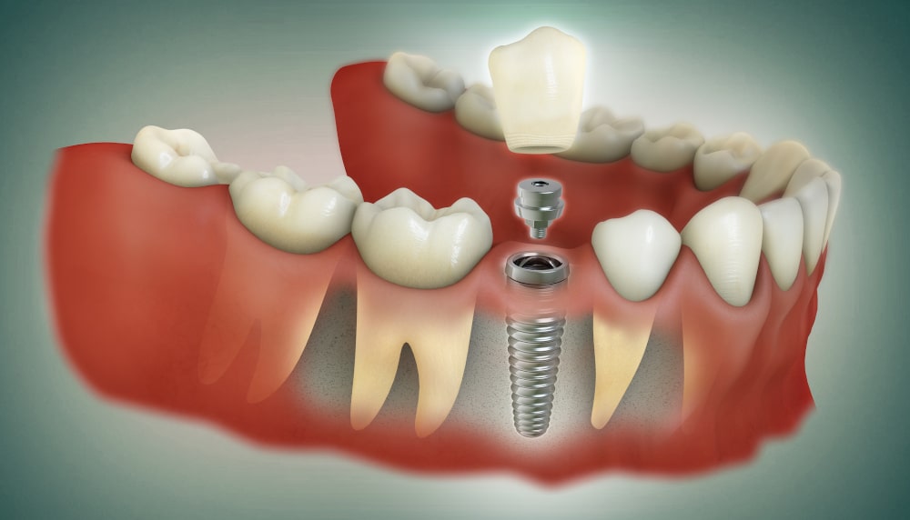 Medical illustration of the dental implant process, including abutment and crown placement