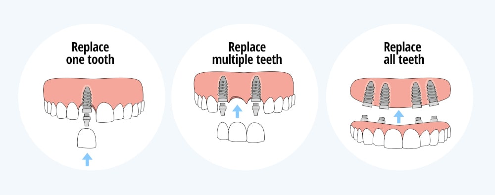 Visual comparison of different types of dental implants including single and full-arch solutions