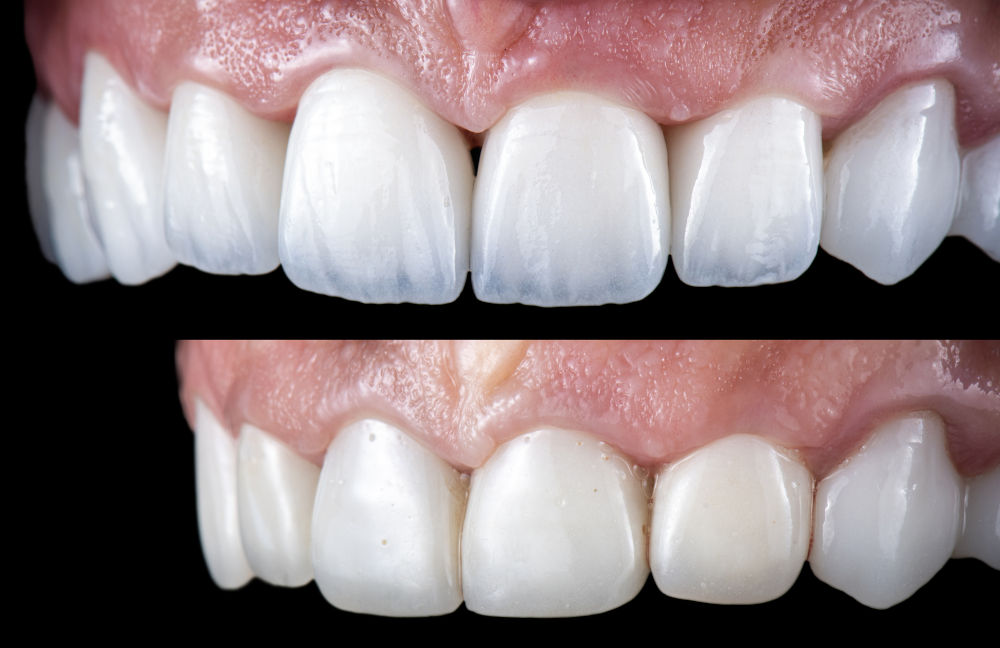 Close-up view of Emax ceramic veneers showing colour variation and material quality used in advanced cosmetic dentistry.