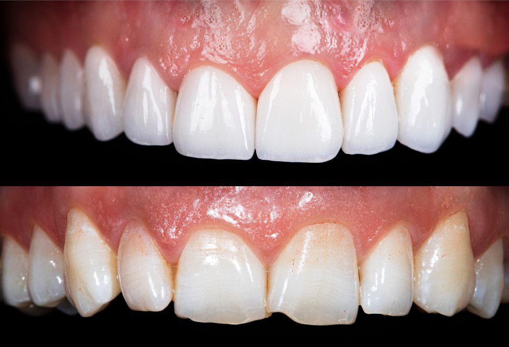 Comparison of teeth appearance before and after cosmetic treatment with dental bonding versus porcelain veneers.