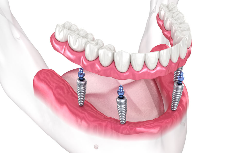 Close-up 3D illustration of a dental prosthesis supported by four implants, showing how implants stabilize dentures.