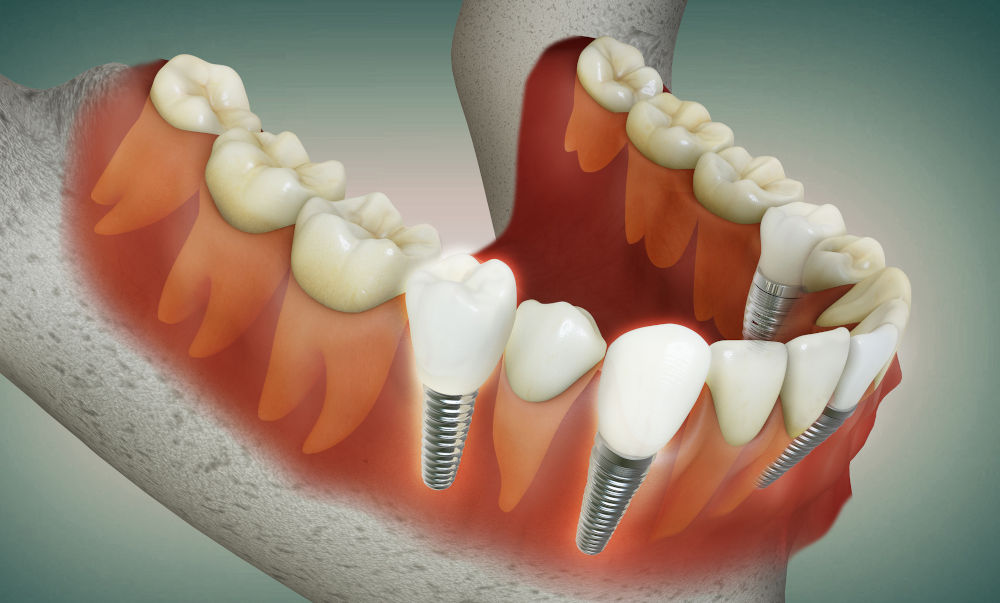 3D illustration of dental implants used to replace missing or severely damaged crooked teeth and restore bite alignment.